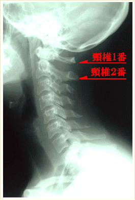 頚椎のレントゲン(頚椎１番・頚椎２番）